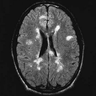 Multiple sclerosis | Neurology | Medicine